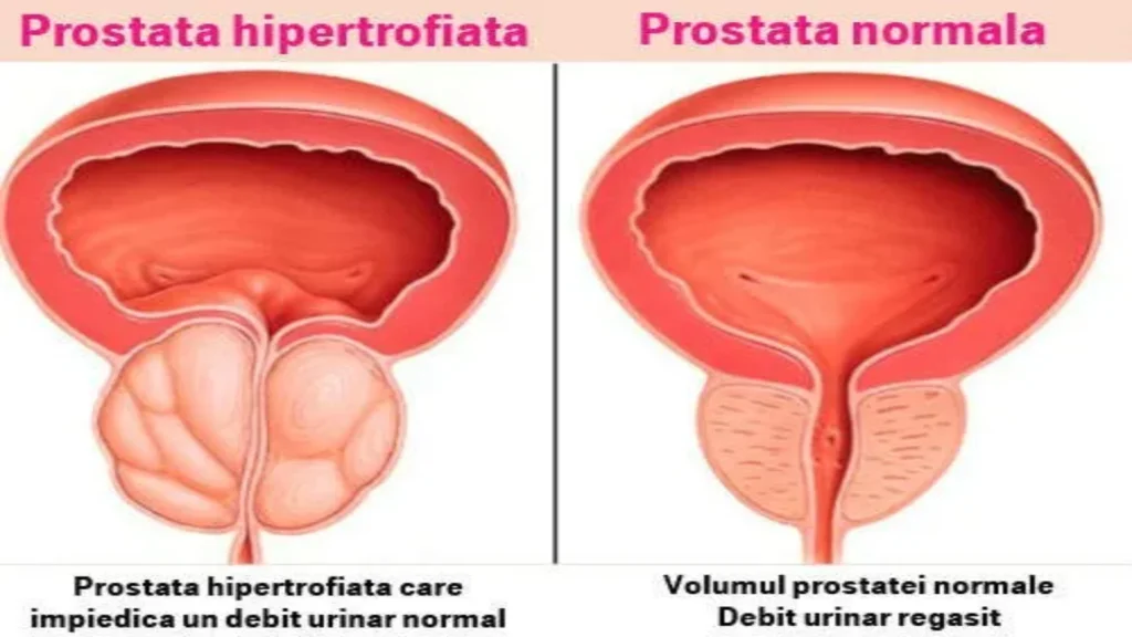 Prostalis - in farmacia - sito ufficiale - Italia - prezzo - recensioni - opinioni - composizione